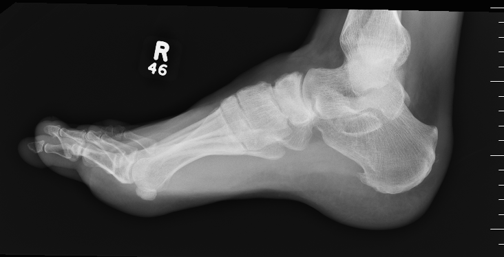 Navicular AVN